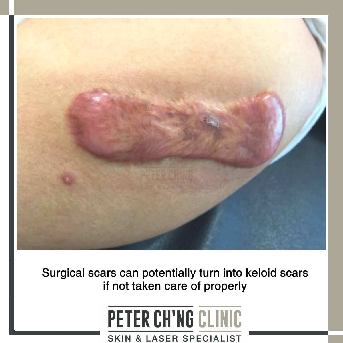 Keloid scar