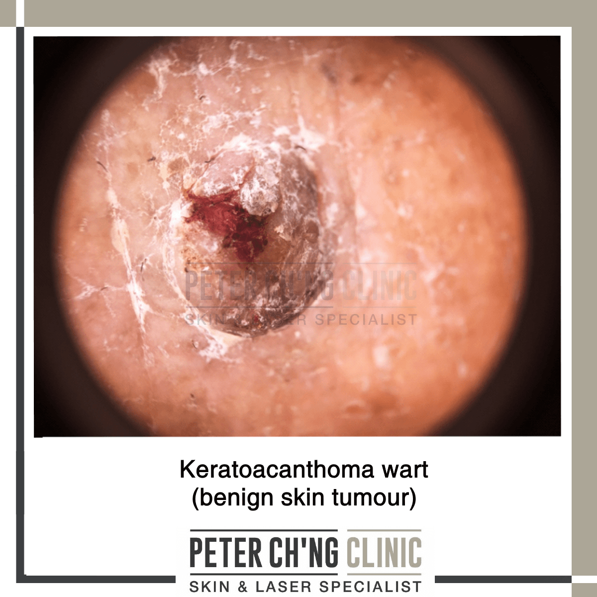 Keratoacanthoma wart