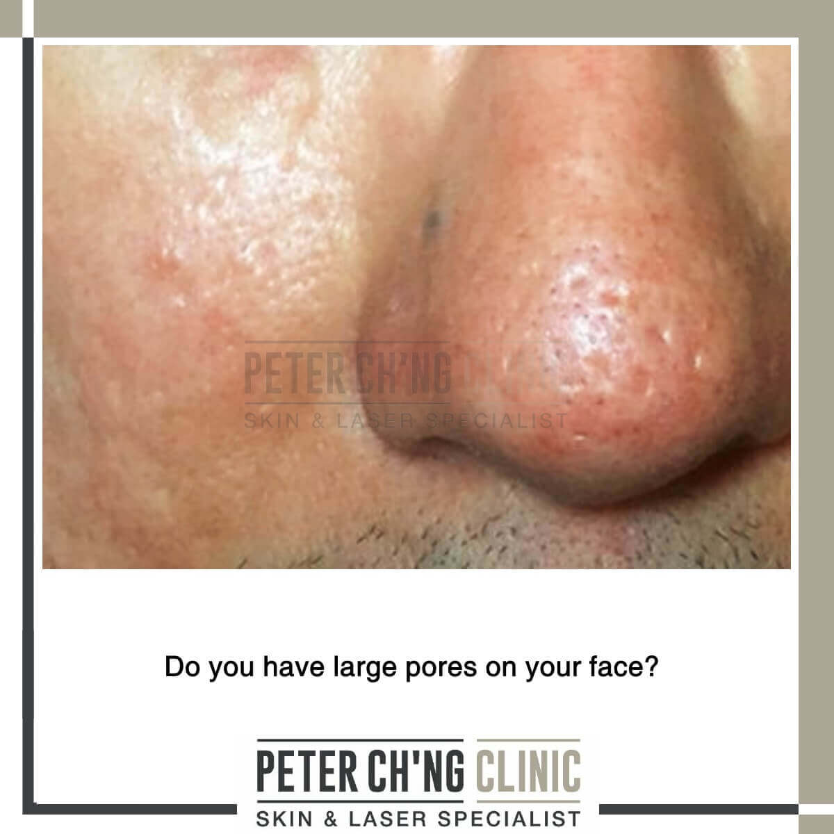 Large pores