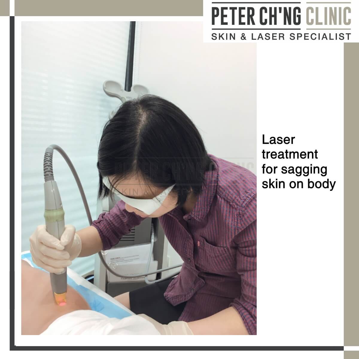 Laser treatment for sagging skin on body