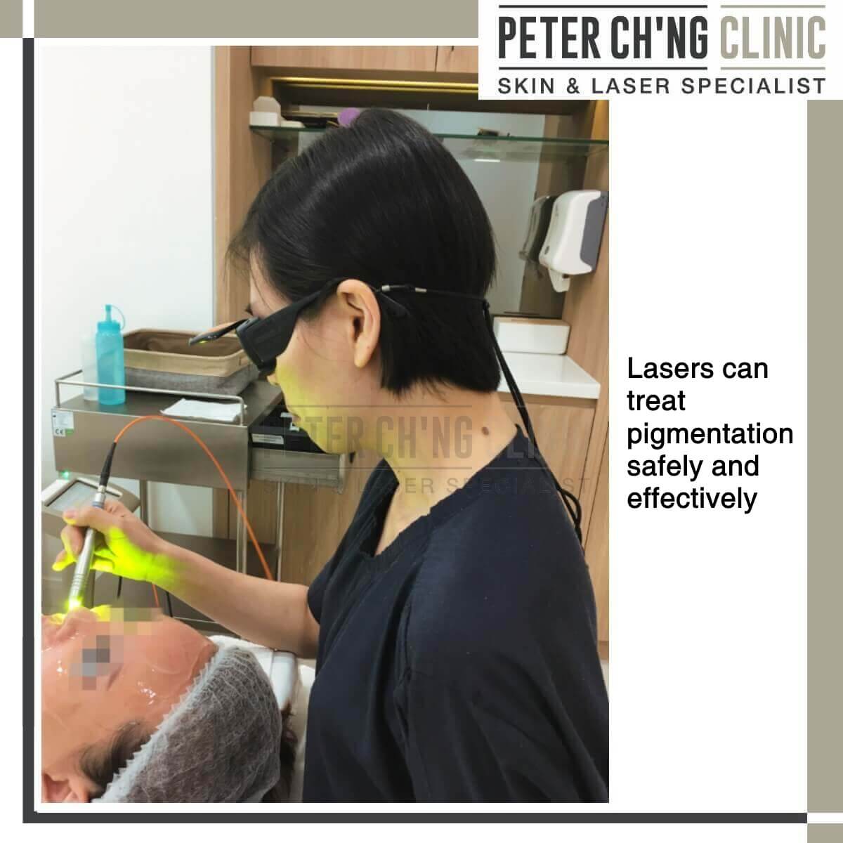 Laser treatment for hyperpigmentation