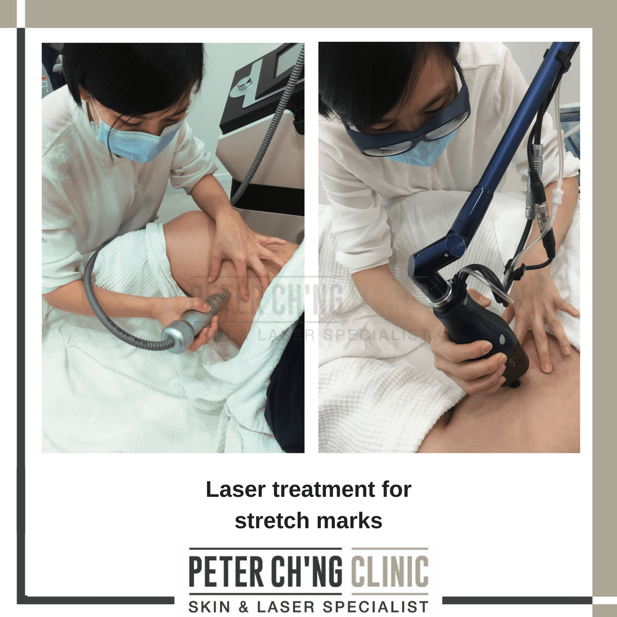 Laser treatment for stretch marks