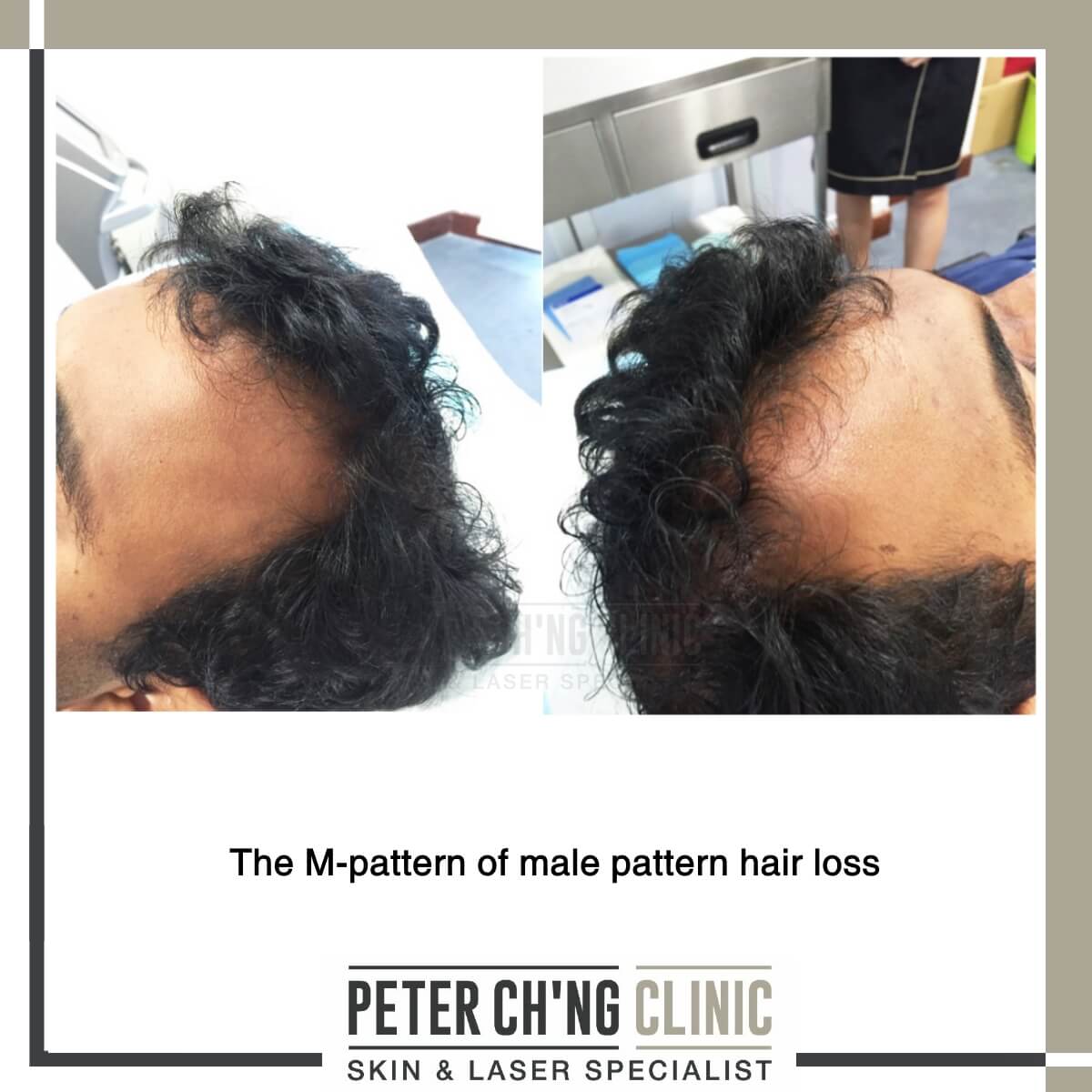 Male pattern hair loss