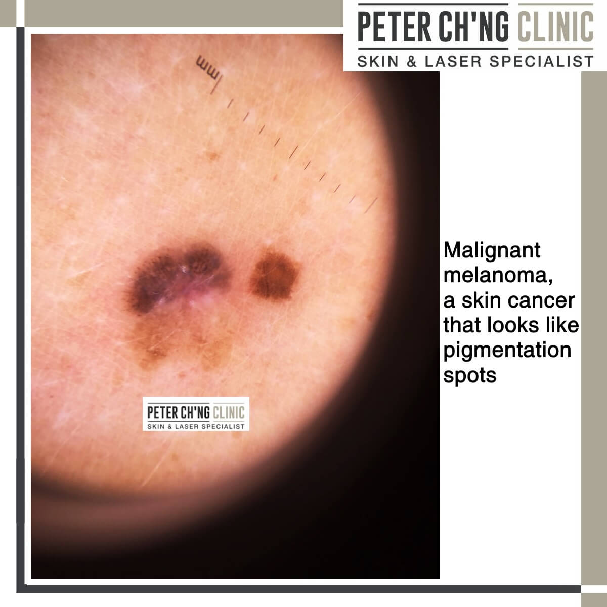 Age Spots Not Necessarily Due To Old Age Peter Ch Ng Skin Specialist Kl Malaysia Age Spots Not Necessarily Due To Old Age Peter Ch Ng Skin Specialist Kl Malaysia