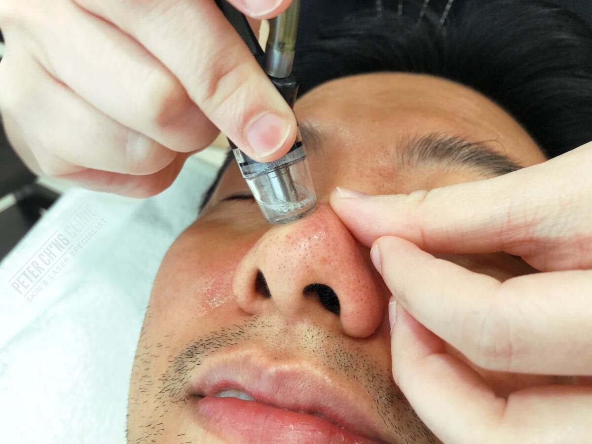 Microdermabrasion