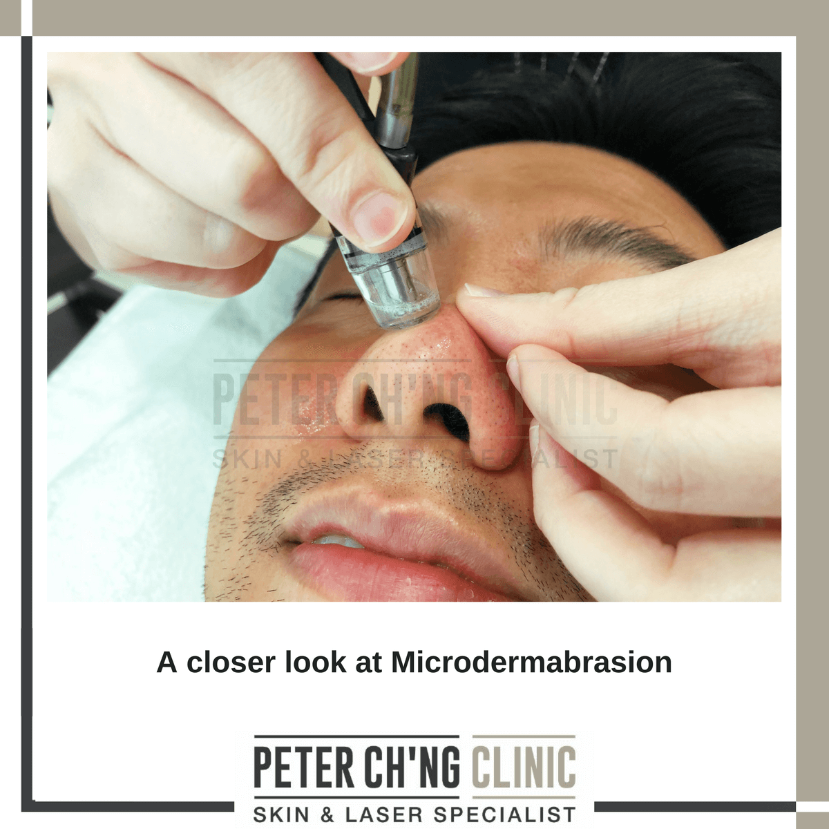 Microdermabrasion