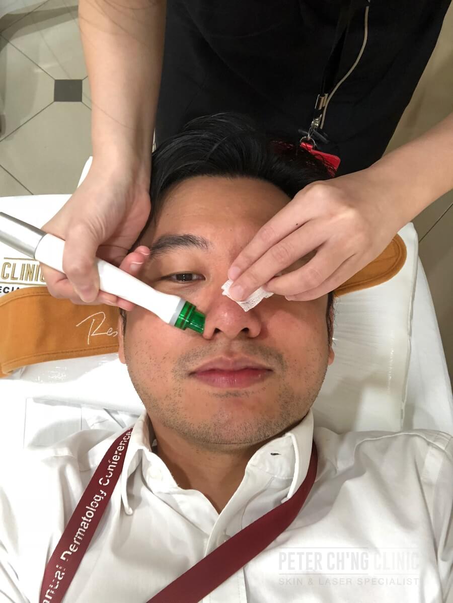 Microdermabrasion