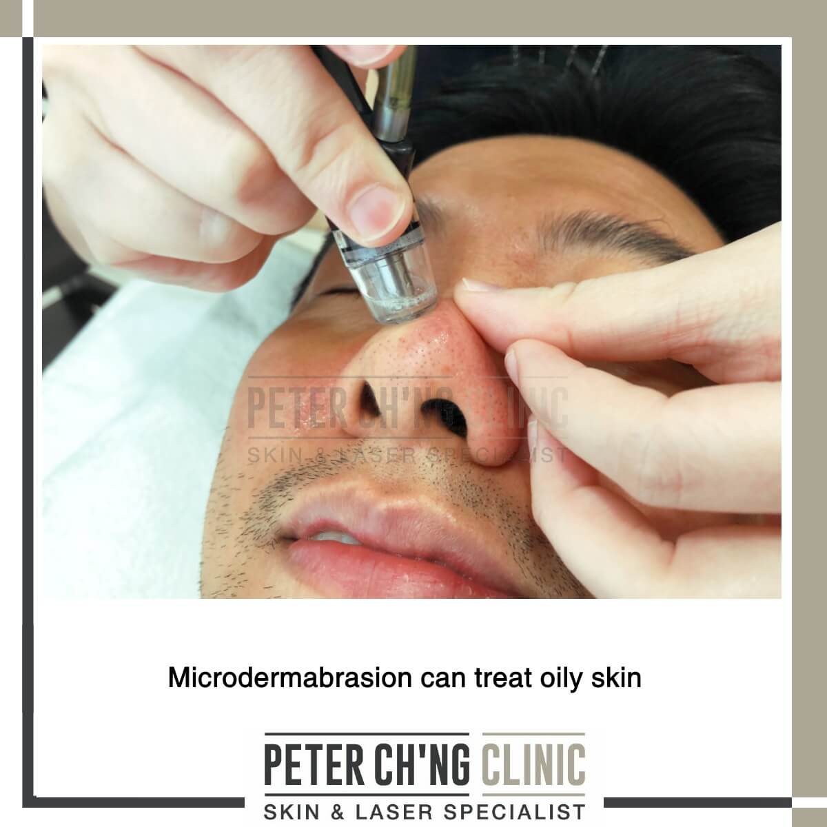 Microdermabrasion