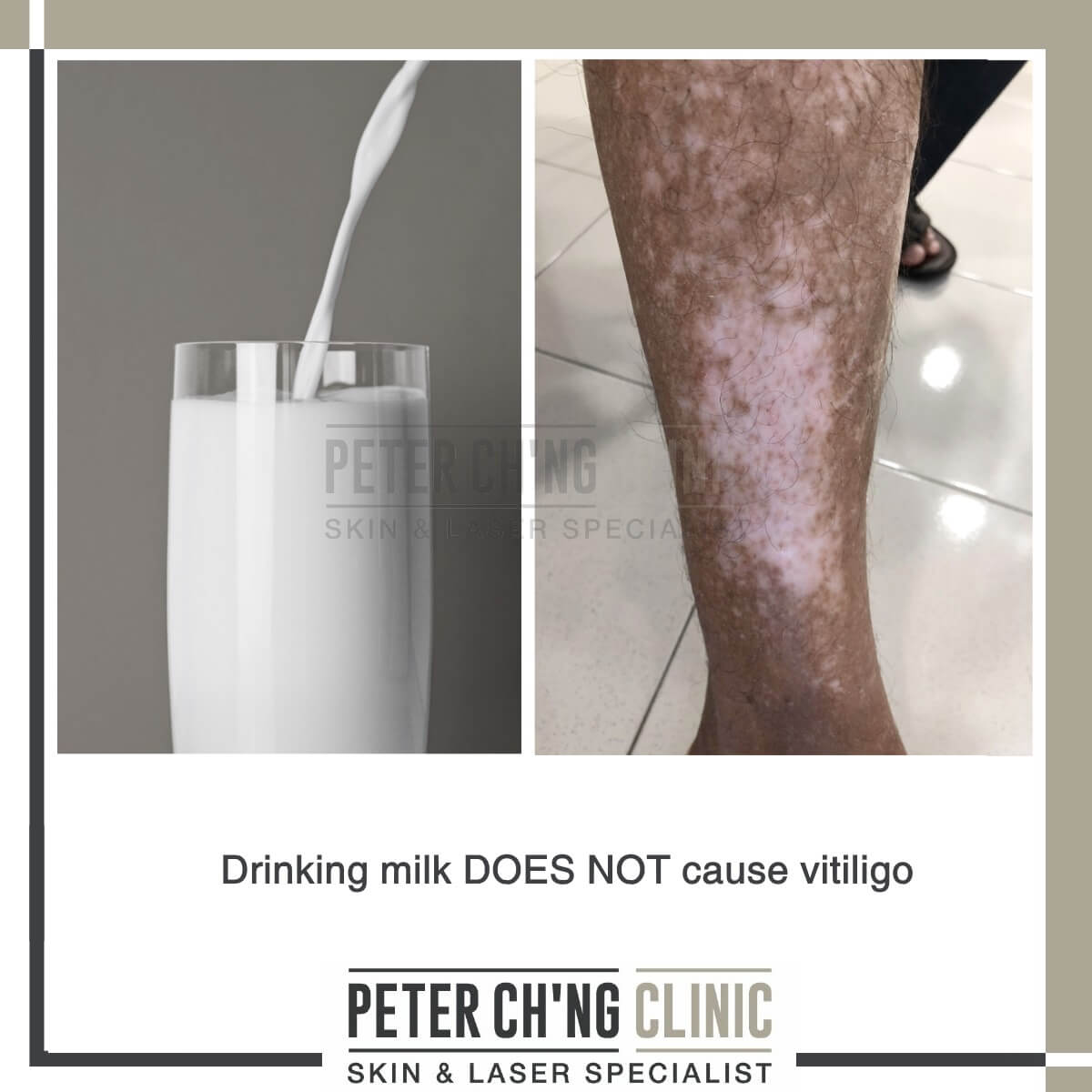 Vitiligo myth