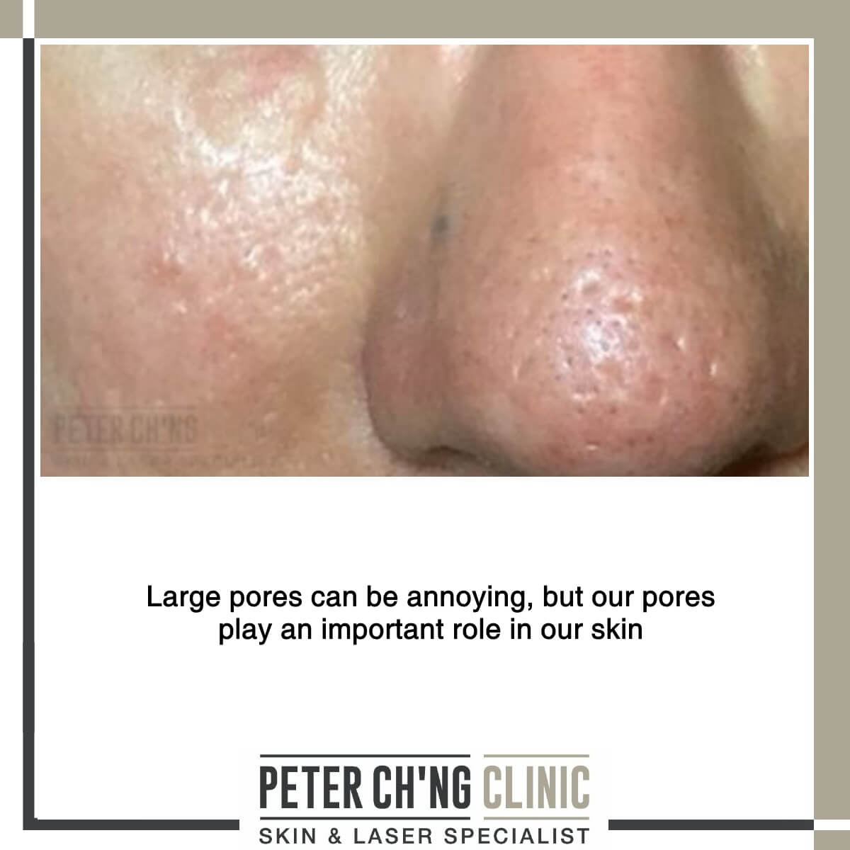 Large pores