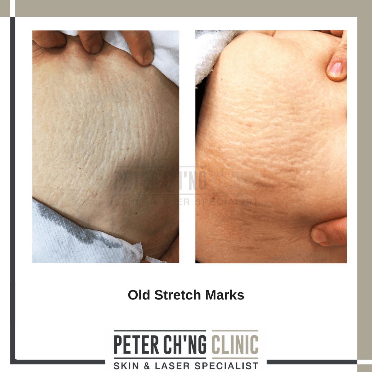 Old stretch marks