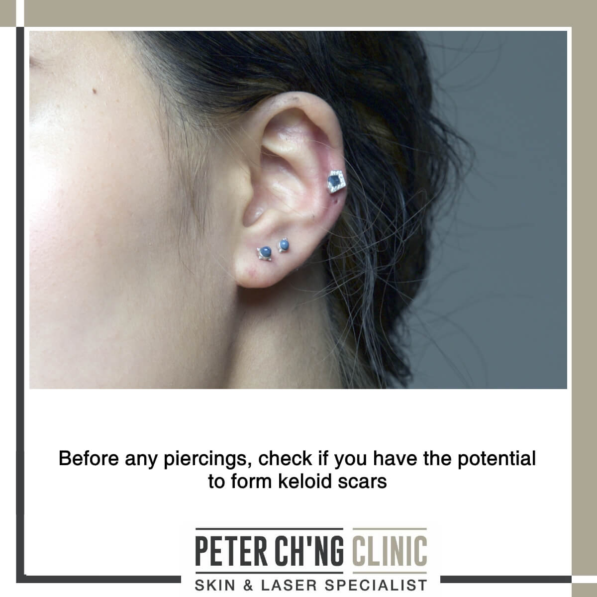 Piercing and keloids