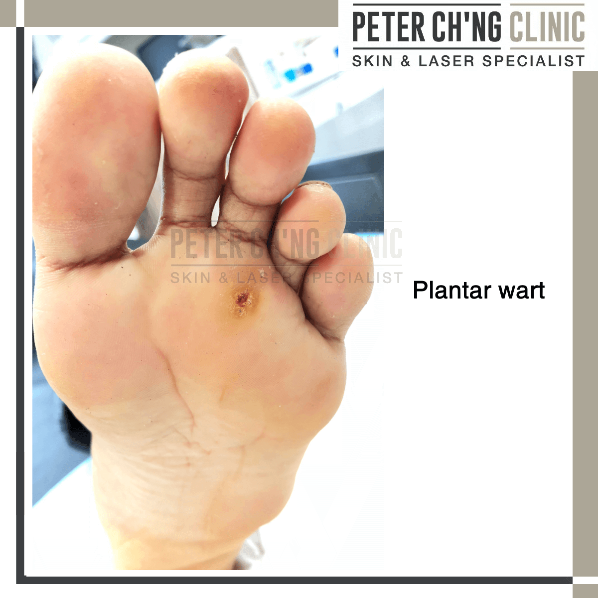 Plantar warts