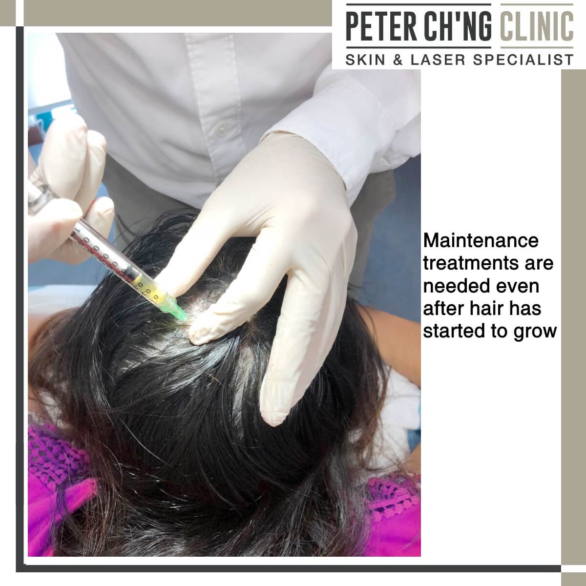 PRP Treatment for Hair Loss