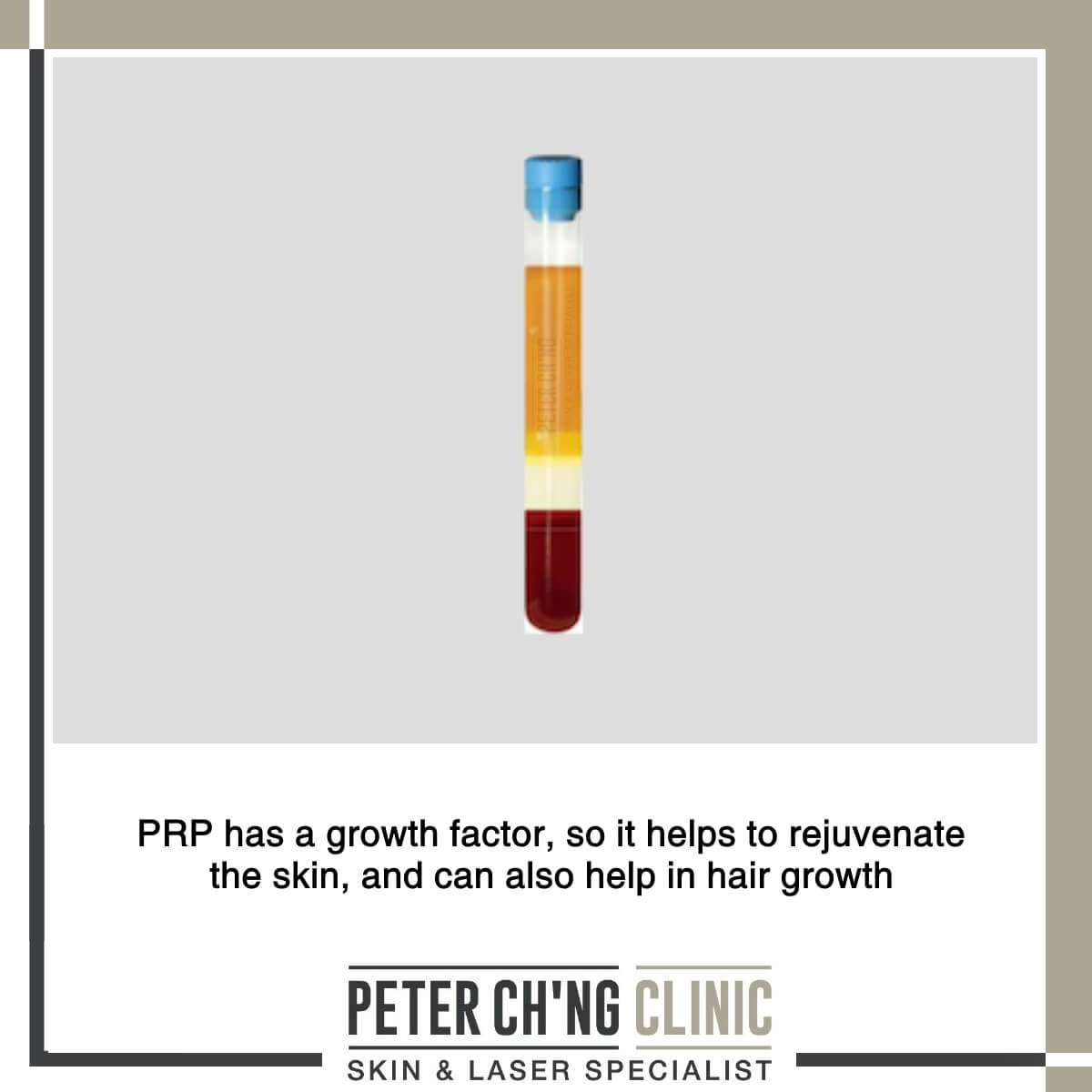 PRP treatment