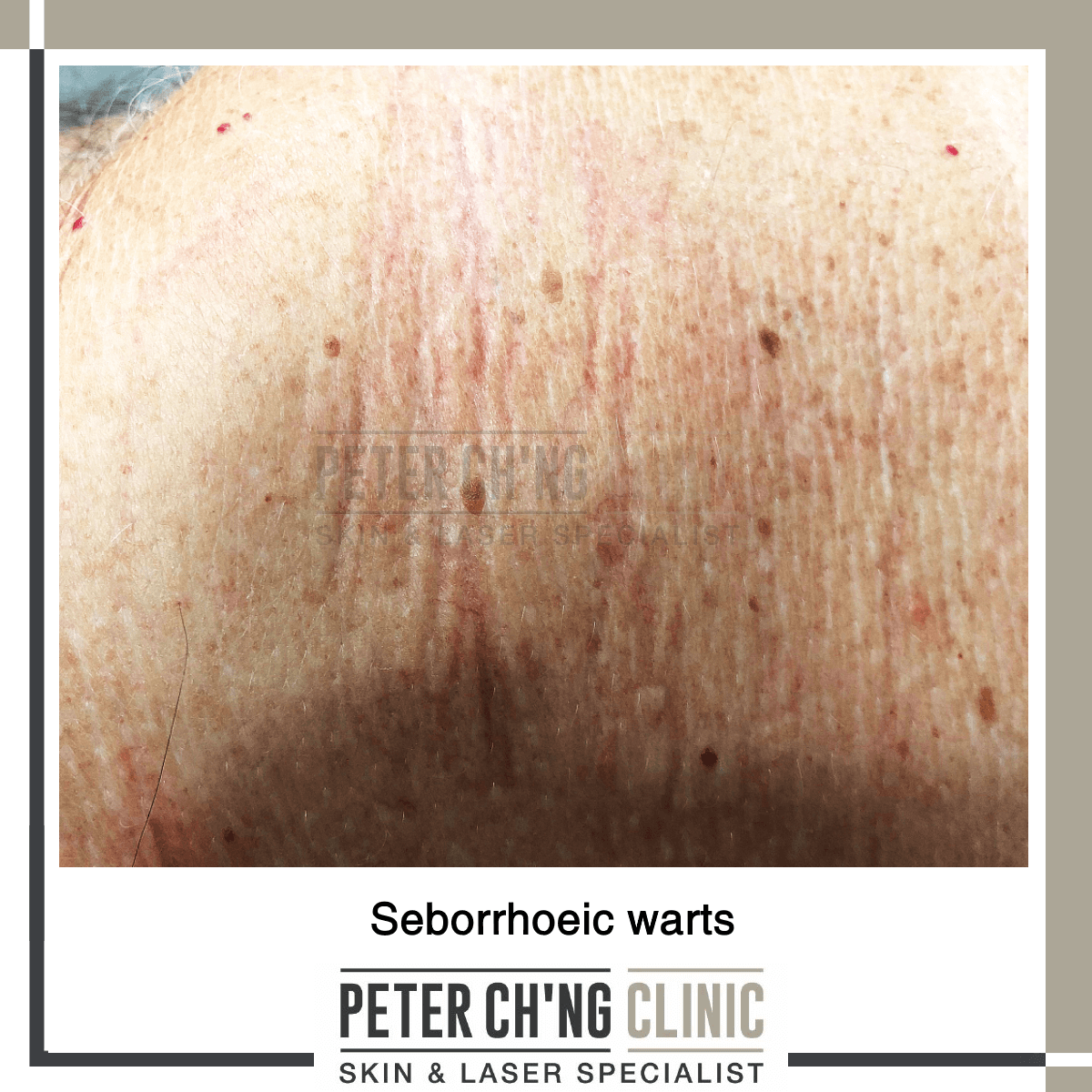 Seborrhoeic warts