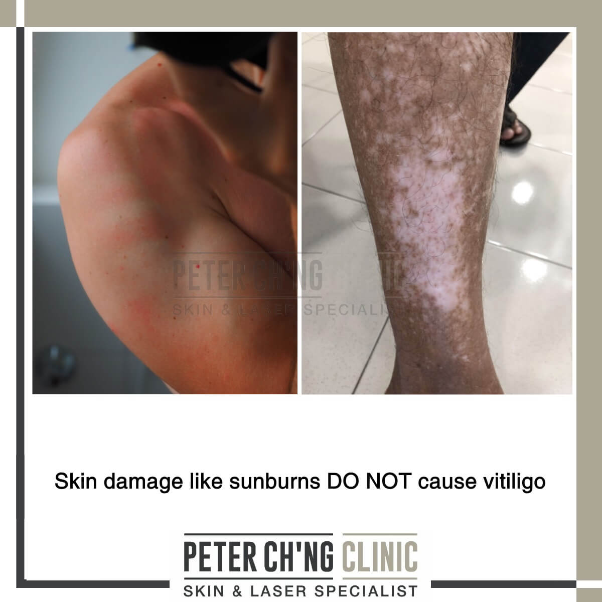 Vitiligo myth