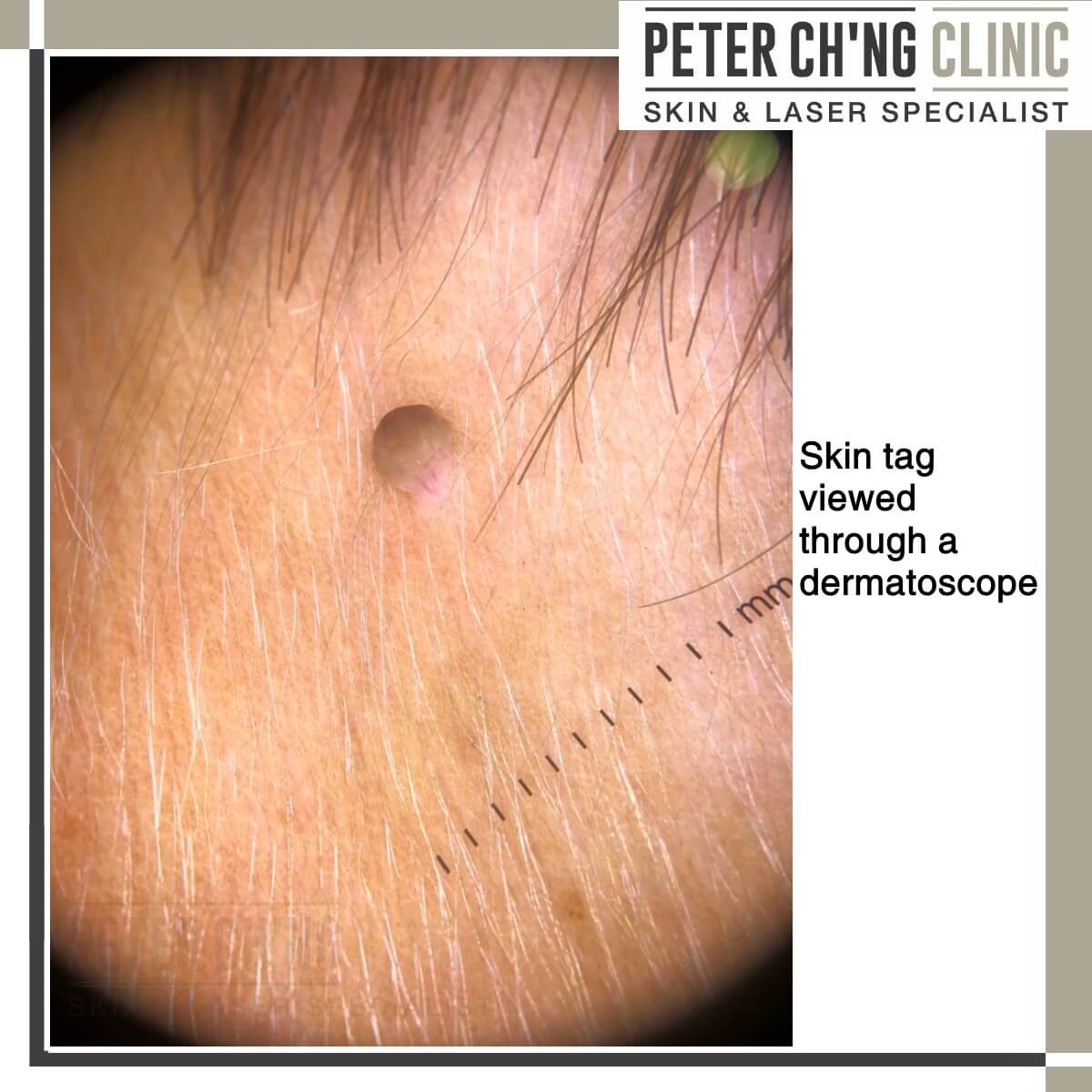 Skin tag dermatoscope