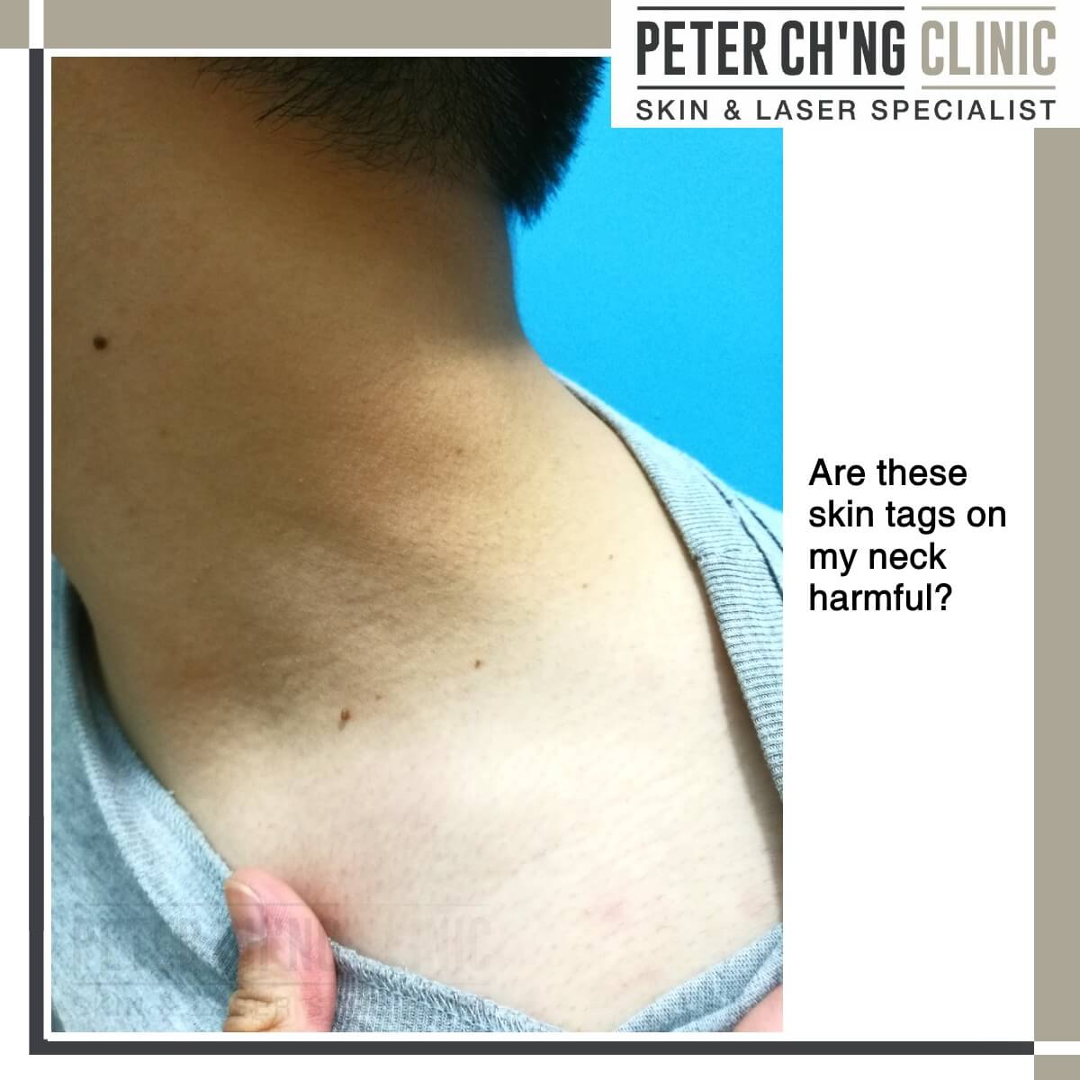 Skin tag