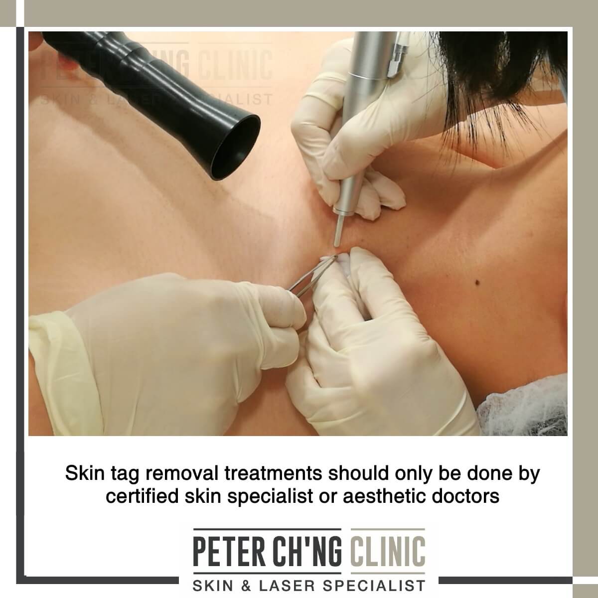 Skin tag removal