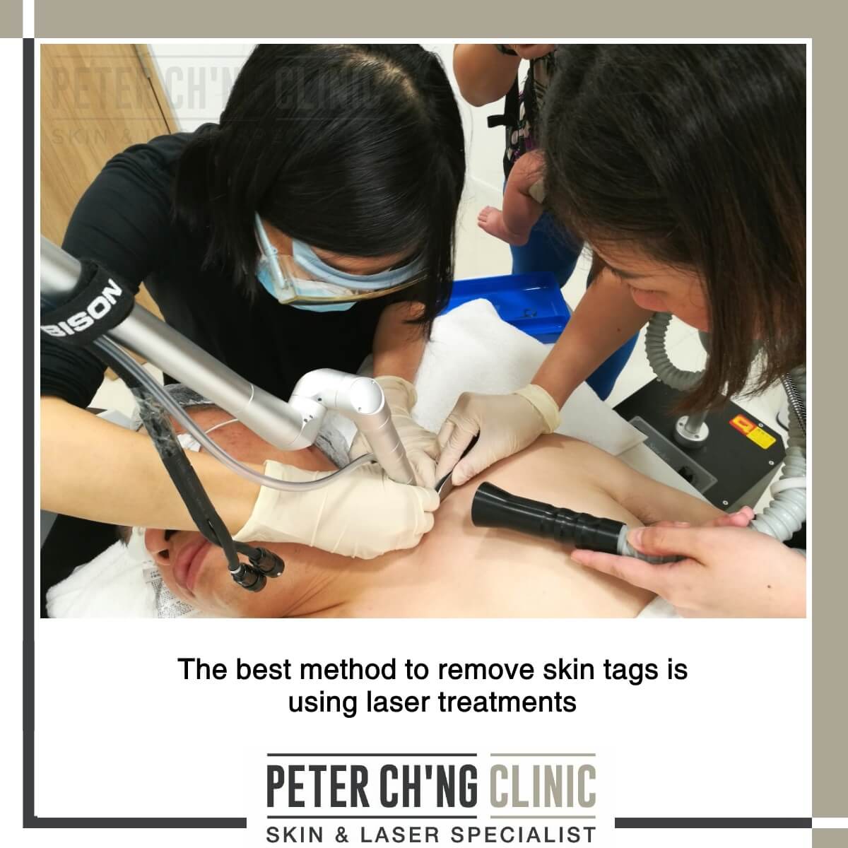 Laser treatment for skin tag