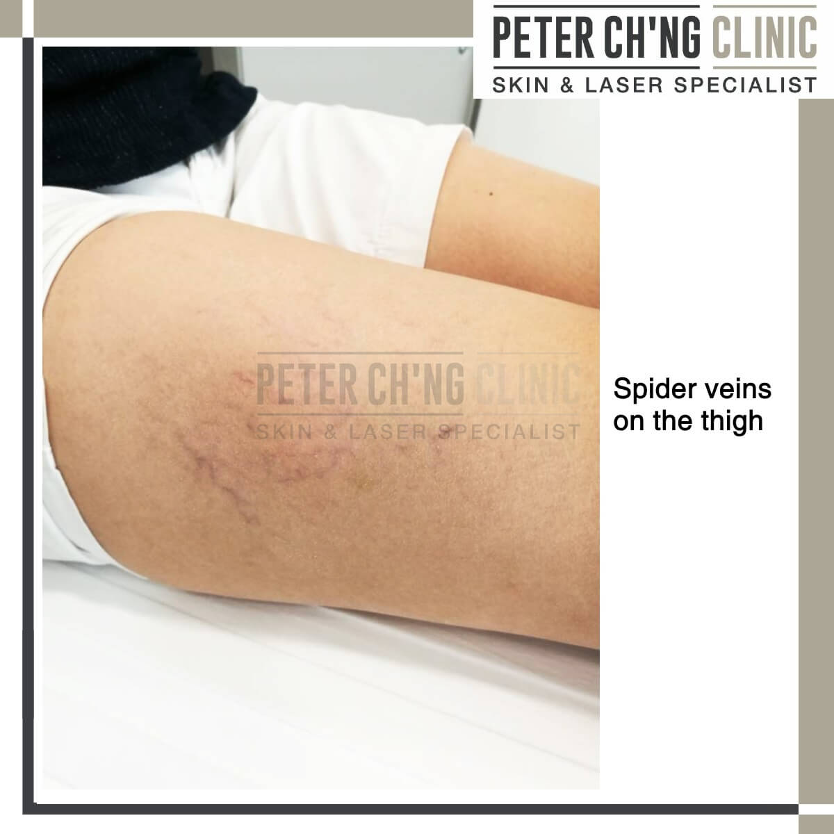 Spider veins