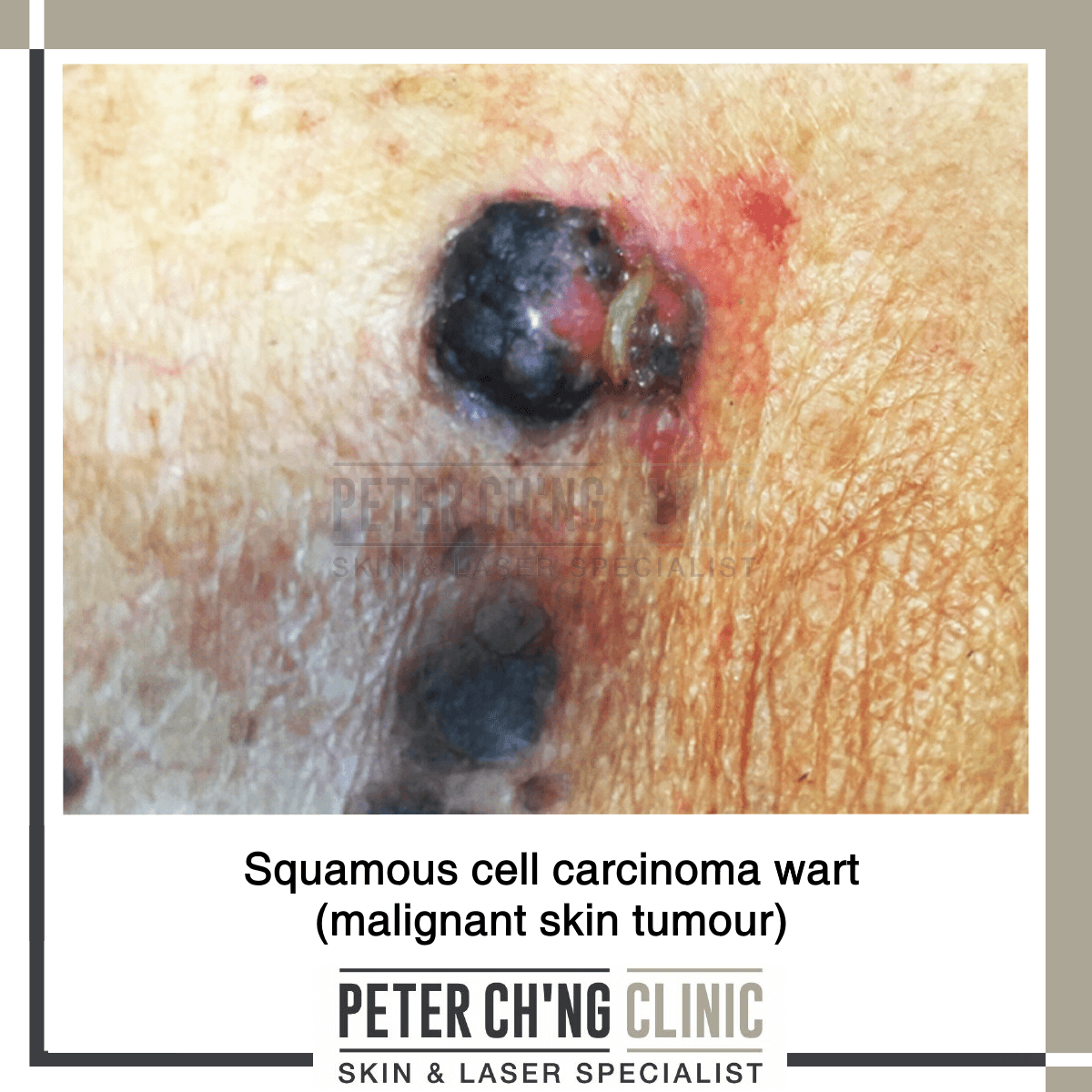 Squamous cell carcinoma wart