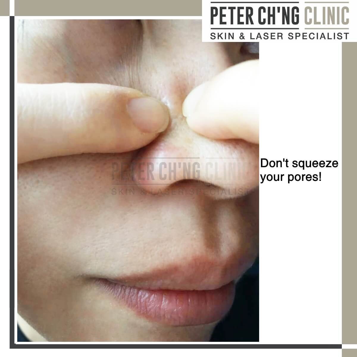 Squeeze pores