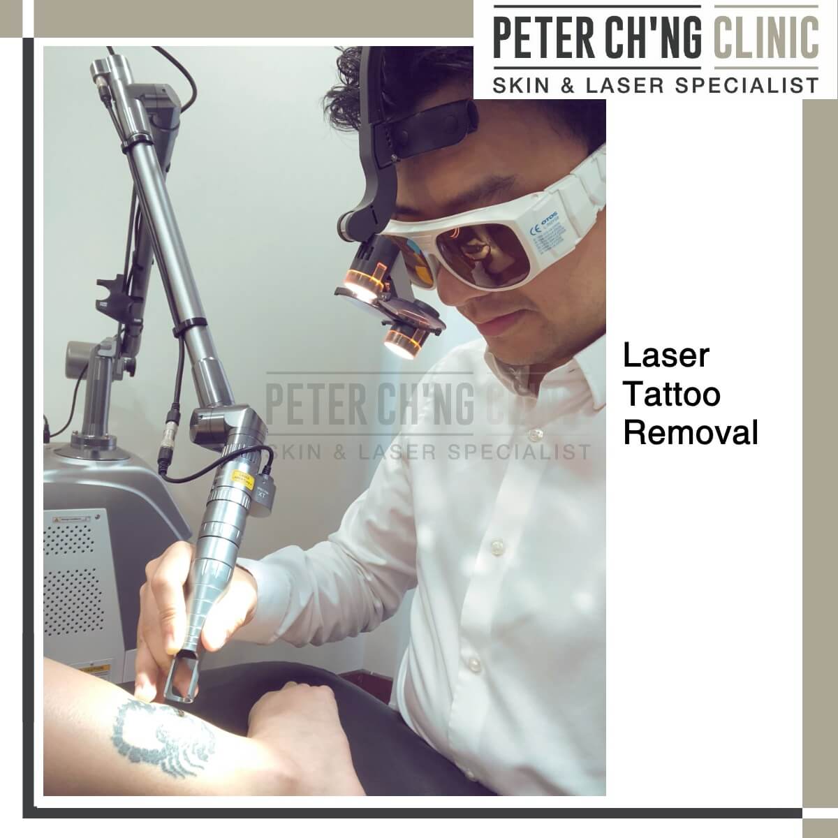 Laser tattoo removal