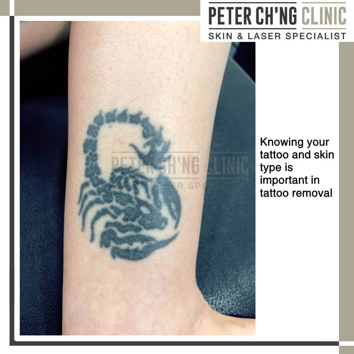 Laser Tattoo Removal | Lexington Tattoo Removal