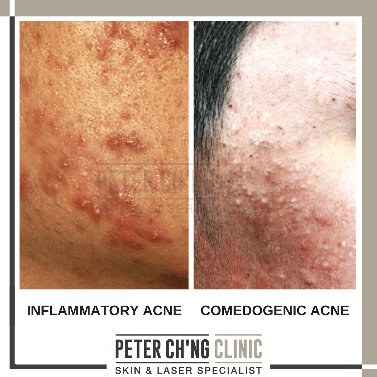 5 Situations Where Acne Can Affect Our Career Peter Chng Skin