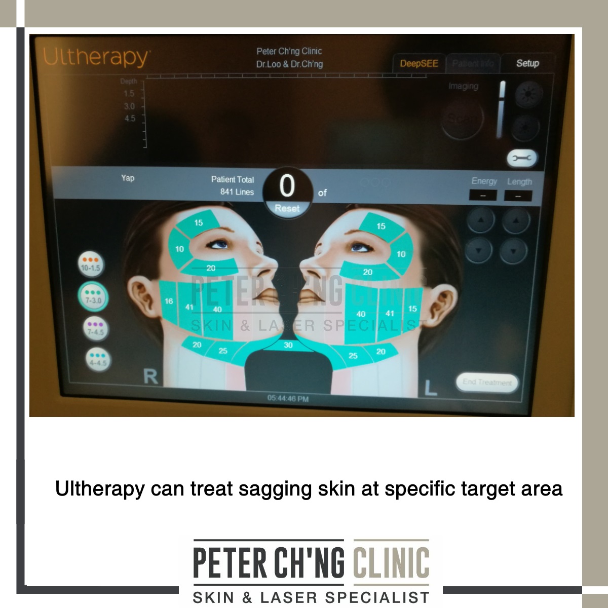 Ultherapy