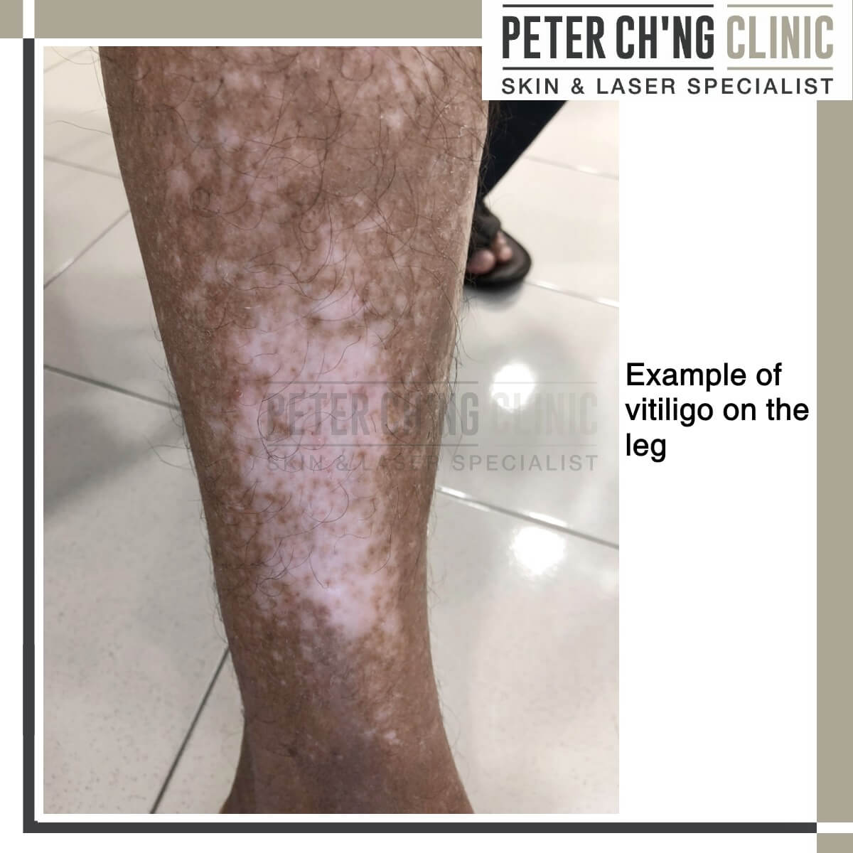 Vitiligo