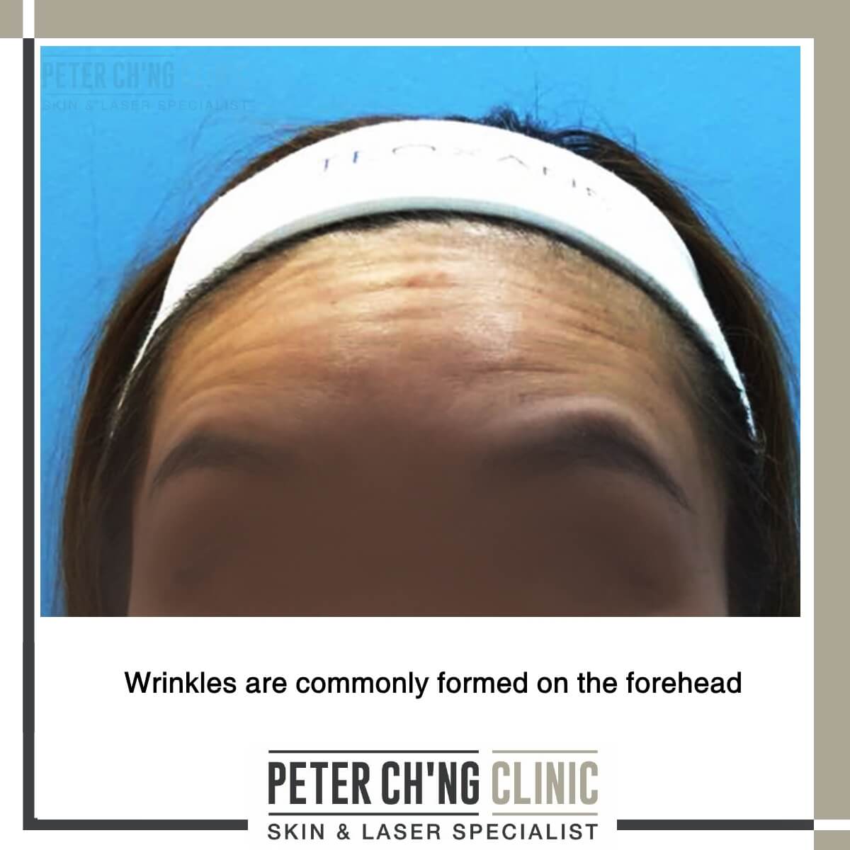 Wrinkles